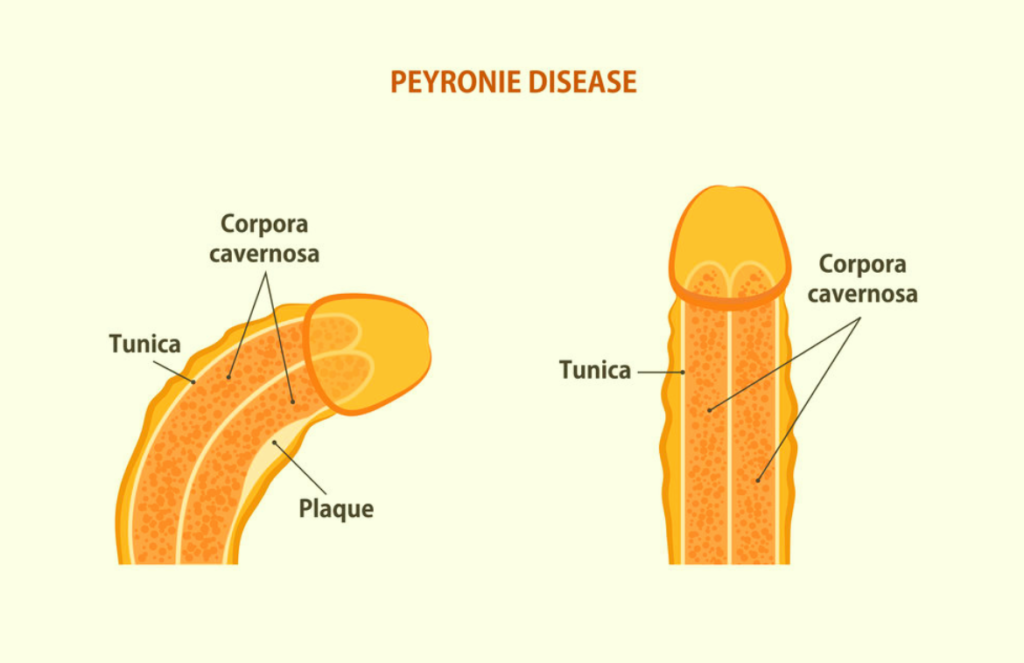 Peyronie’s disease Overview, Symptoms, and Treatment Options