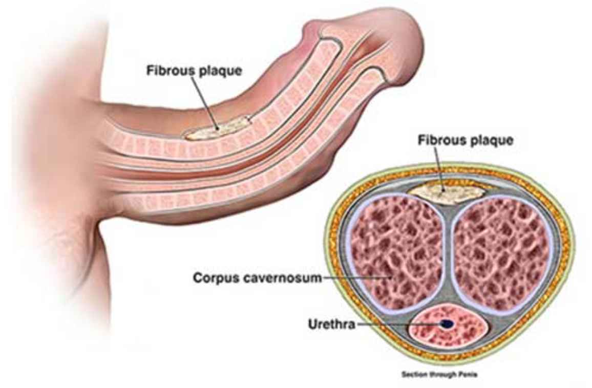 Early stages of Peyronie’s disease