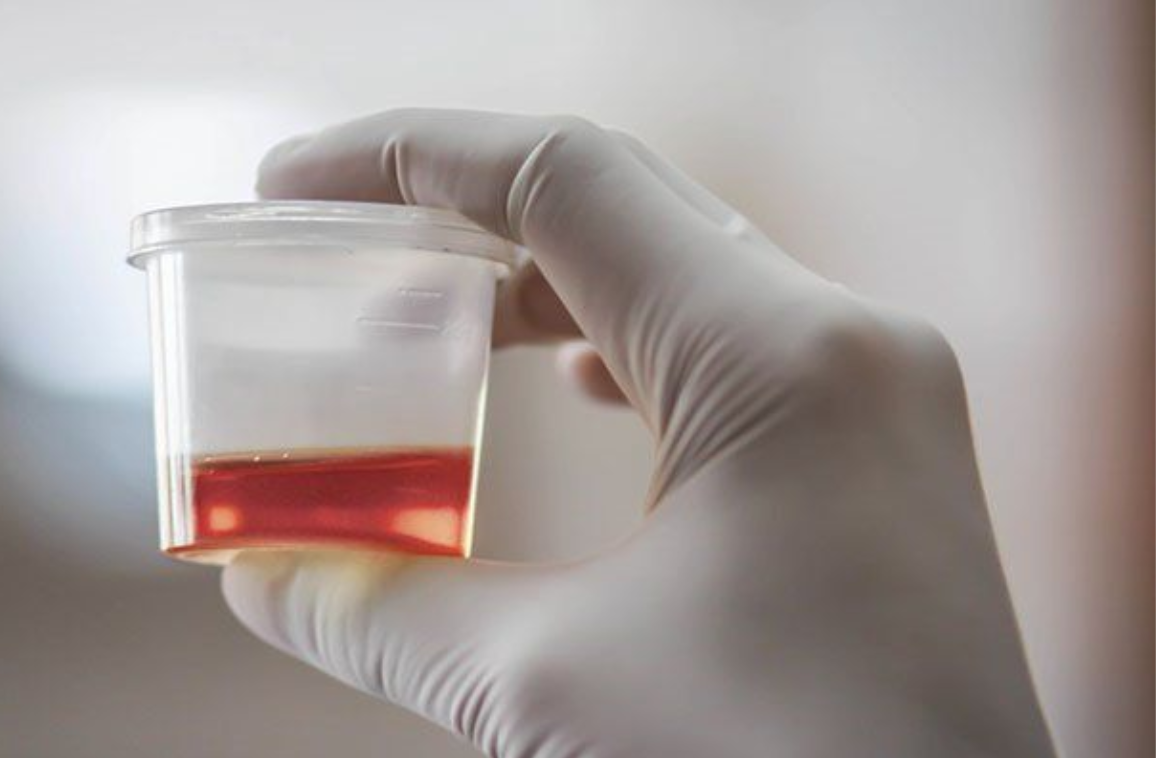 Blood in the urine