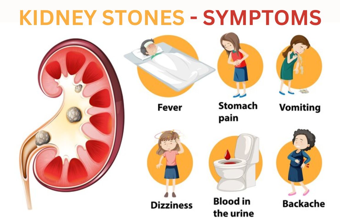 7 Kidney Stone Symptoms: Are You at Risk?