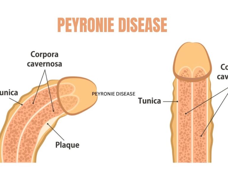 Peyronie’s Disease symptoms