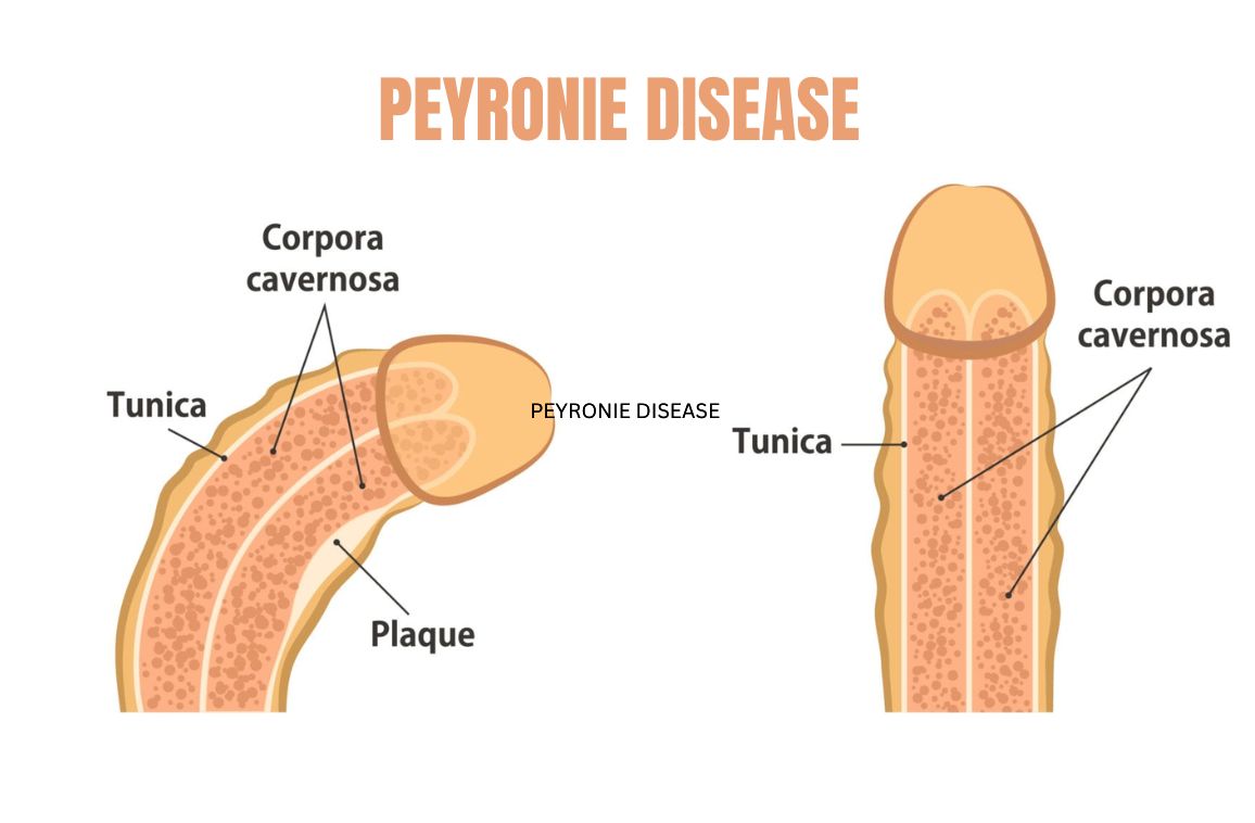 Peyronie’s Disease symptoms