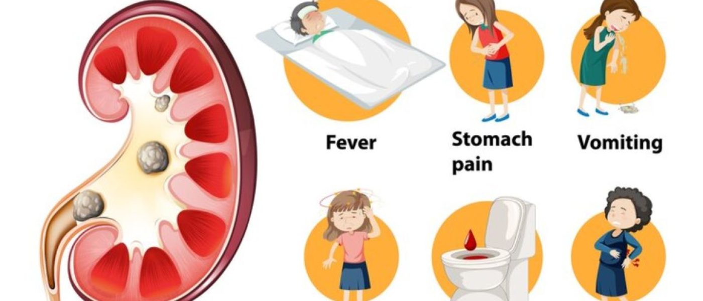 7 Kidney Stone Symptoms: Are You at Risk?