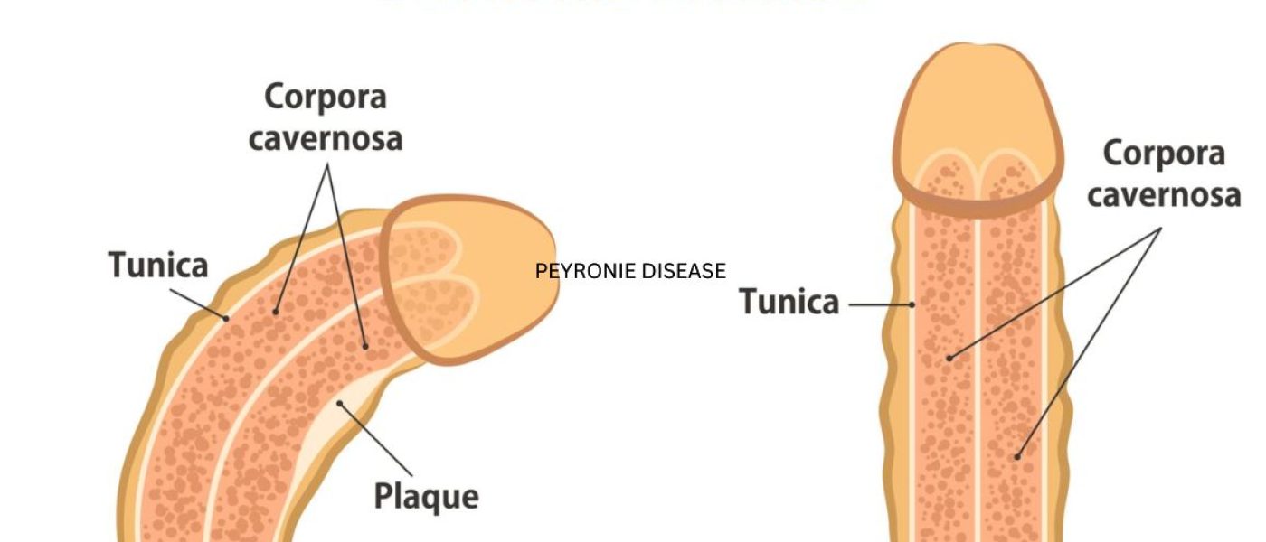 Peyronie’s Disease symptoms